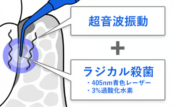 超音波振動＋ラジカル殺菌（405nm青色レーザー・3％過酸化水素）