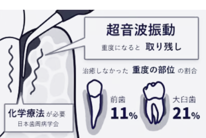 従来の治療法：超音波振動のみのため重度になると歯石の取り残しがあり化学療法が必要。治癒しなかった重度の部位の割合は前歯11％・大臼歯21％（日本歯周病学会）